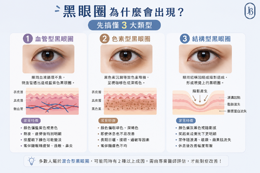 黑眼圈為什麼會出現?先搞懂 3 大類型 黑眼圈為什麼會出現?先搞懂 3 大類型